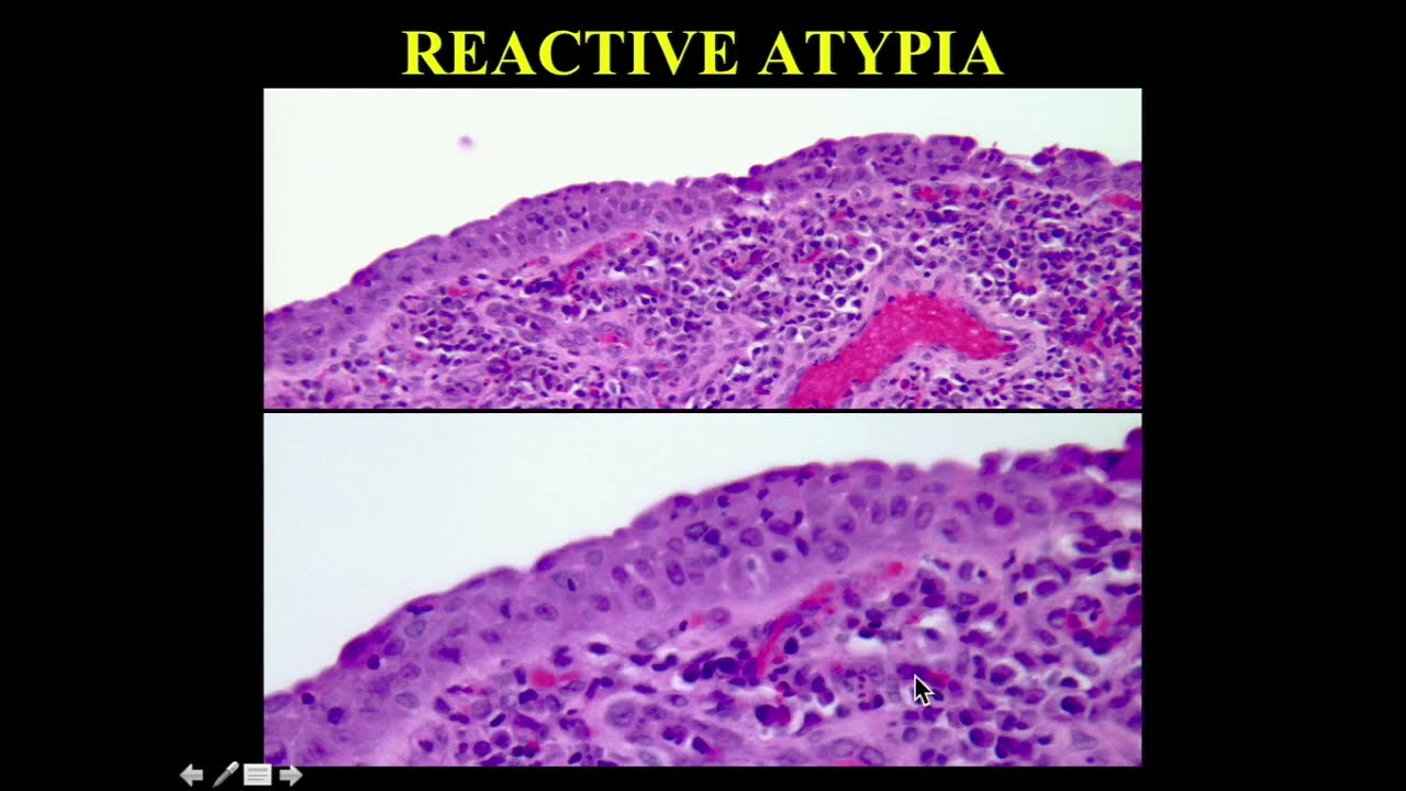 Classic Lectures in Pathology: What You Need to Know: Genitourinary - A Video CME Teaching Activity