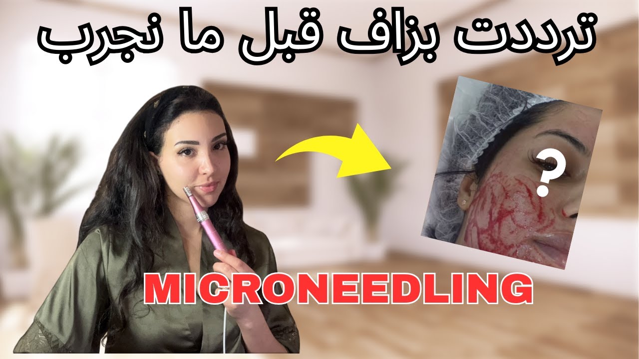 “جربت Dermapen ✨ | واش فعلاً كيبدّل البشرة؟”