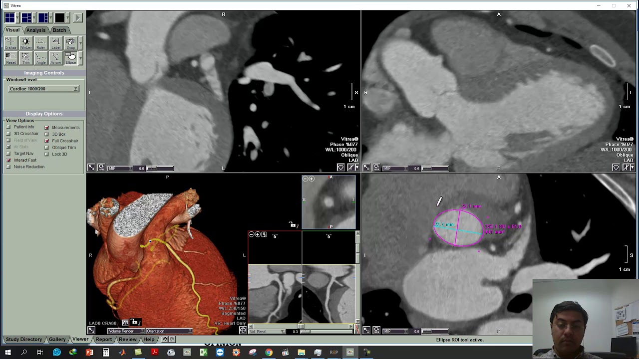 Annular plan in pre-TAVI by Vitrea