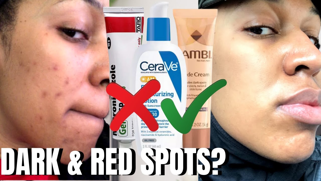 Treating Hyperpigmentation *AND* Rosacea (Black Skin)