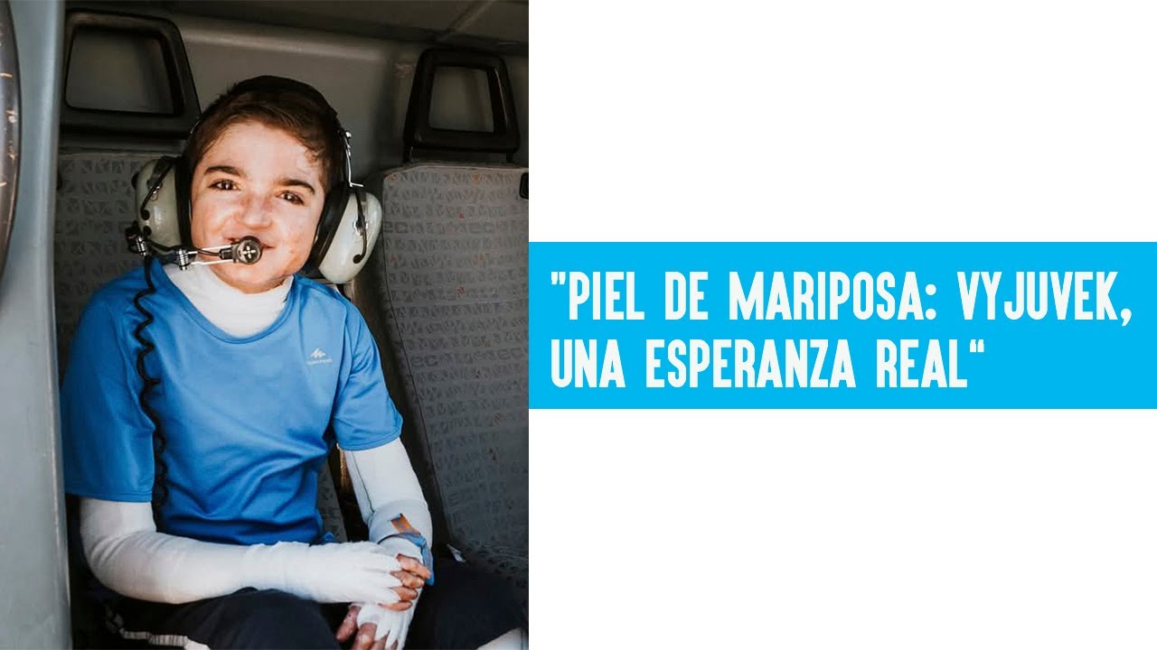 Piel de mariposa: el tratamiento Vyjuvek que podría cambiar la vida de Adrián
