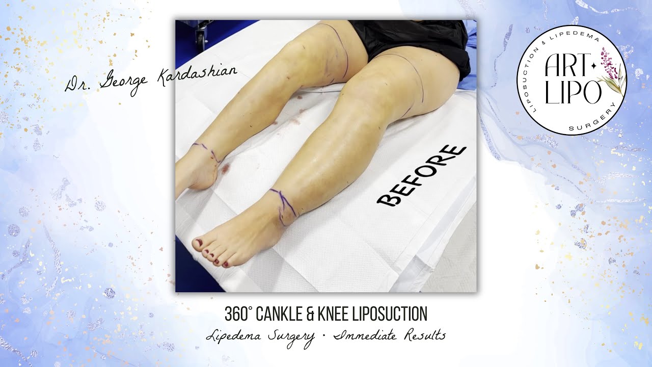 360&deg; Cankle & Knee Liposuction | Lipedema Surgery | Artlipo | Expert Dr. George Kardashian