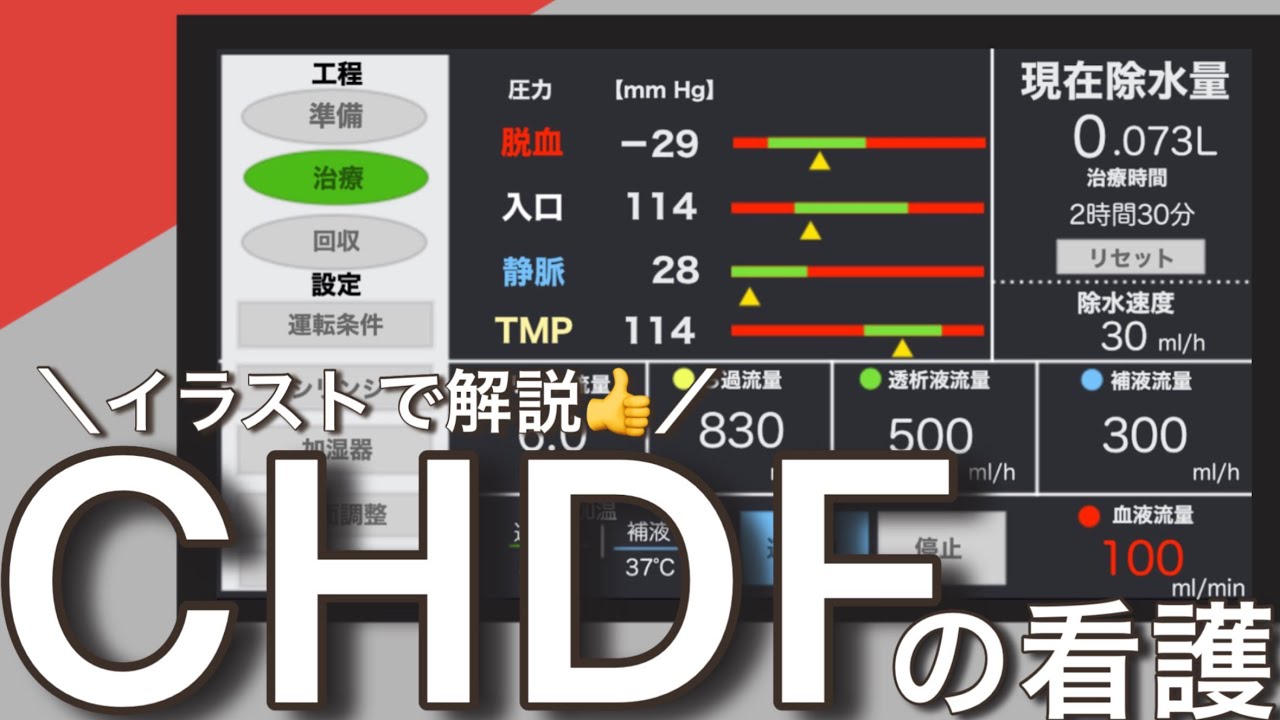 敗血症でも実施される持続透析 CHDFの看護や管理について