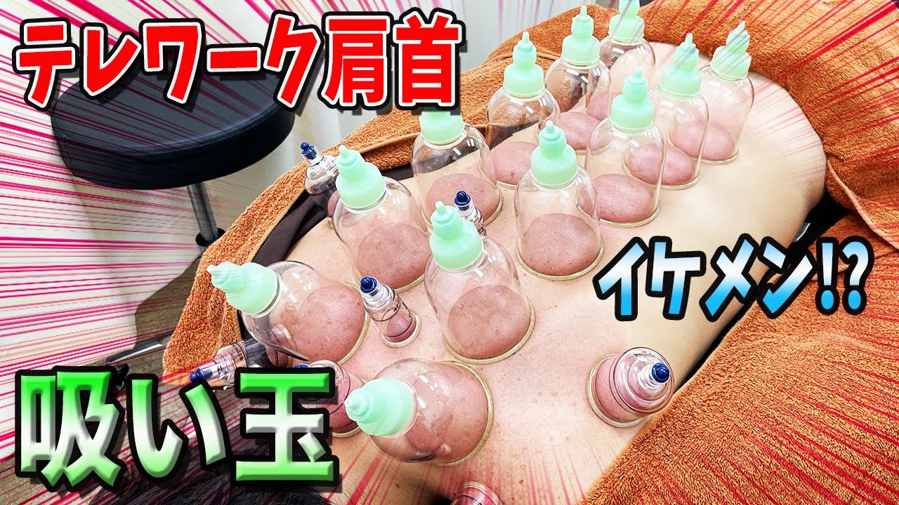 【吸い玉 整体 大阪】テレワークで痛めたイケメンの肩首を吸い玉と整体で改善！大阪で吸い玉整体なら東大阪市たかだ整骨院へ！