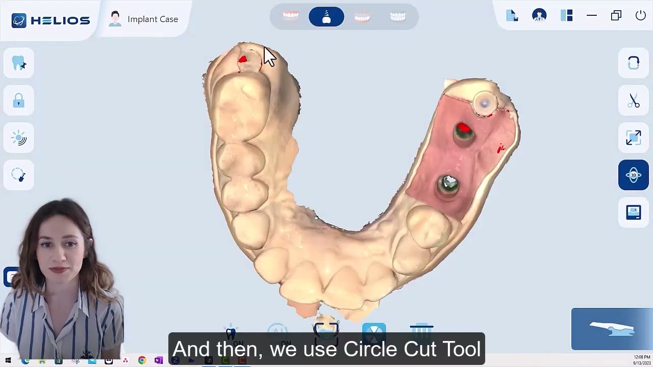 1 Helios 500 Implant Workflow