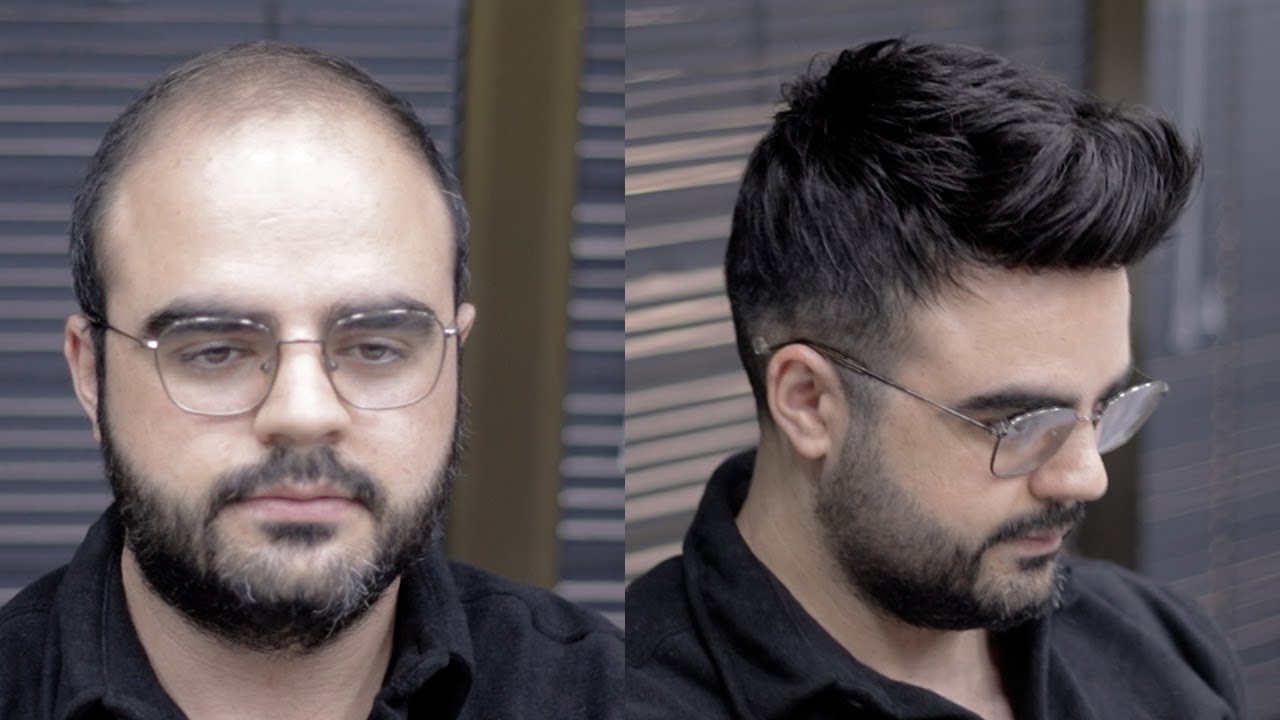 PROTEZ SAÇ UYGULAMASI - Hair Replacement
