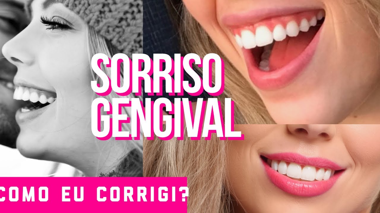 Como eu corrigi meu sorriso gengival?