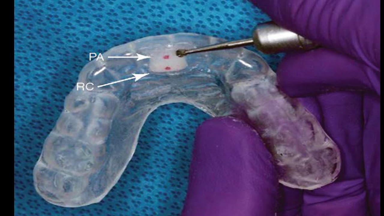 FÉRULA REPOSICIONAMIENTO ANTERIOR