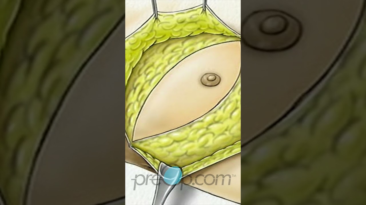 🩺 Total Mastectomy Explained! #shorts #preop #CancerAwareness 🎗️
