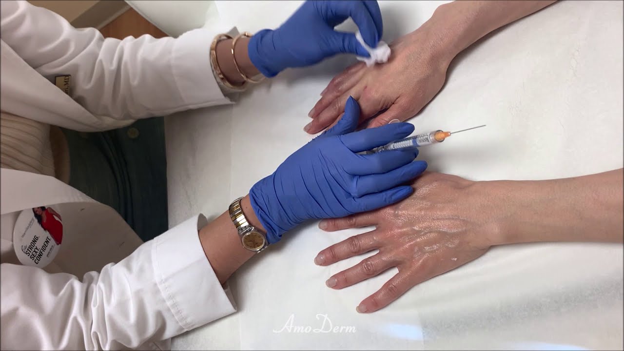 See Dr. Jafari performing hand rejuvenation with filler injection