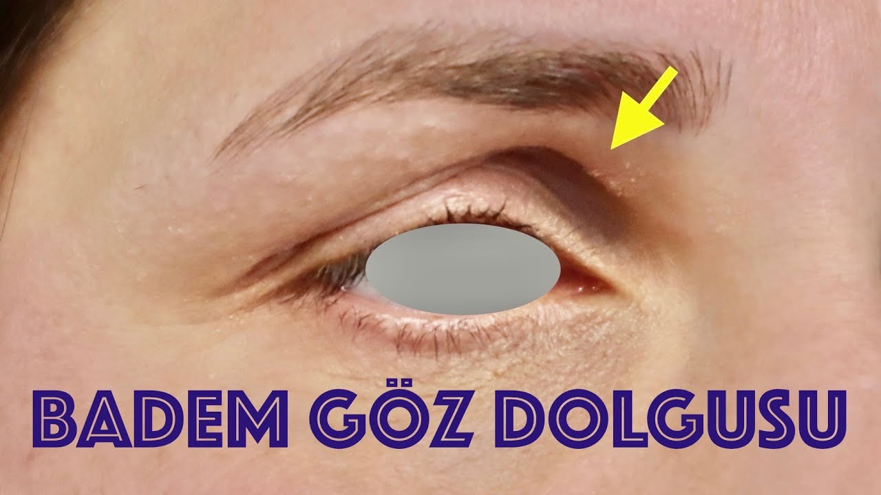 BADEM GÖZ DOLGUSU NEDİR? (Çukur göz tedavisi) Uzm. Dr. Bülent Bağcı