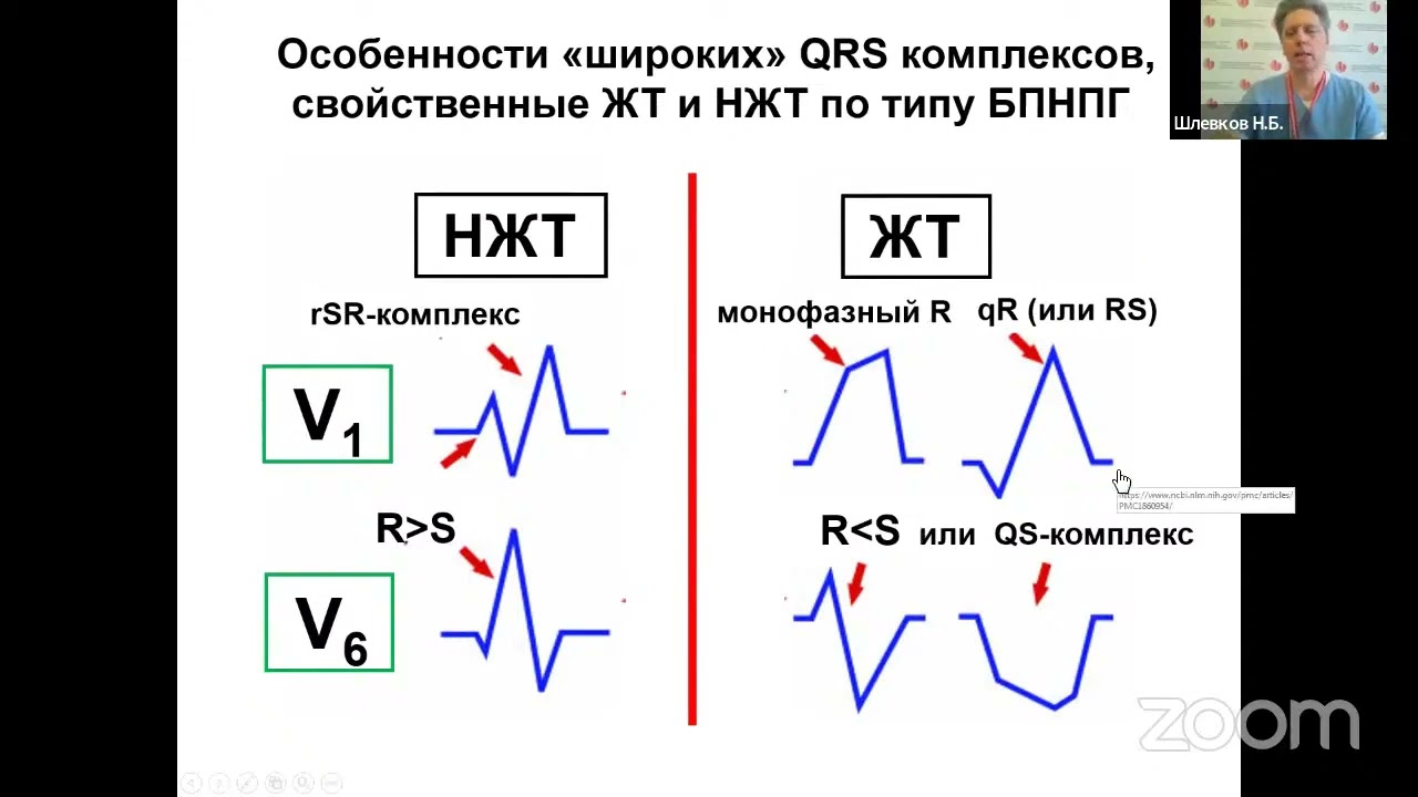 Новые ЭКГ-критерии дифференциальной диагностики тахикардий с широкими комплексами QRS