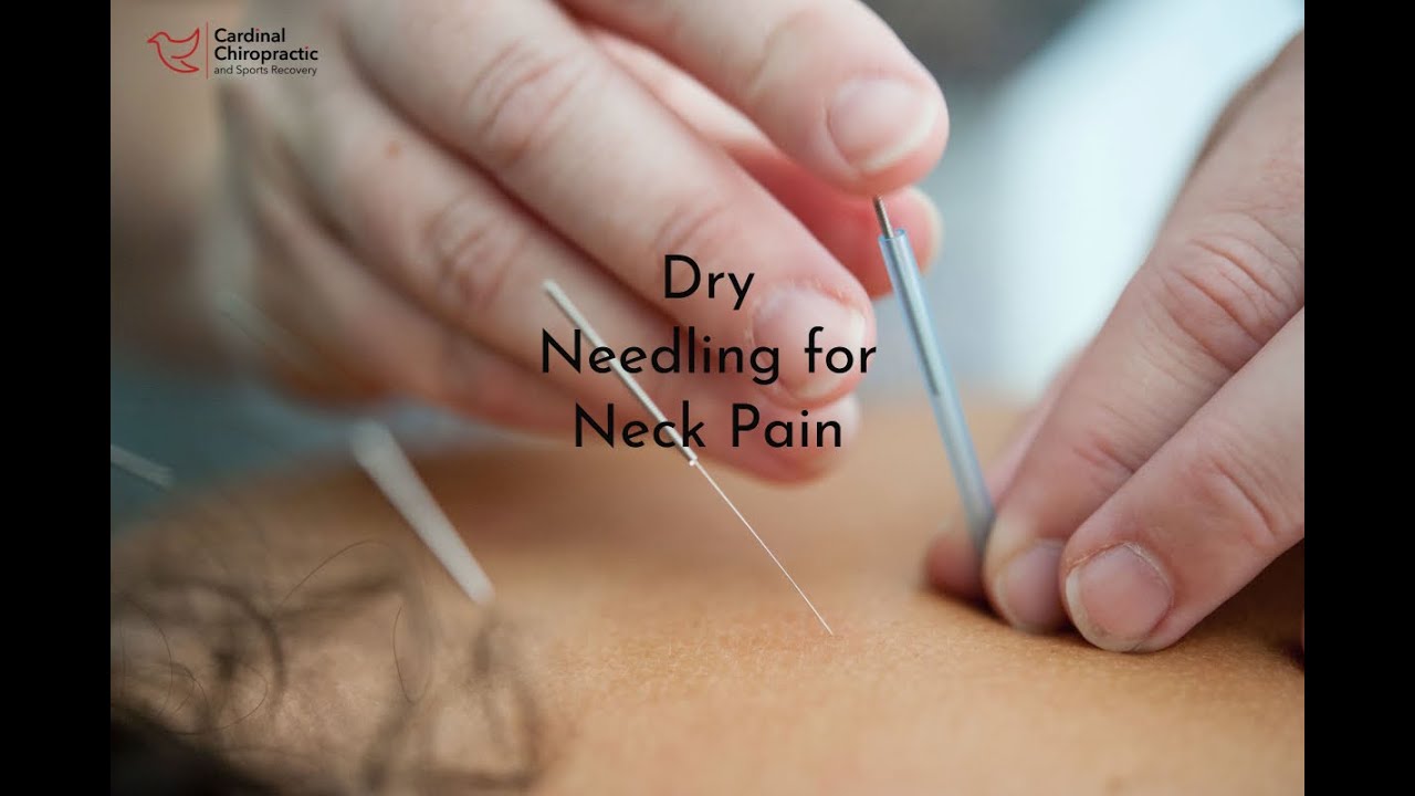 Dry Needling for Neck Pain - Your Burlington NC Chiropractor