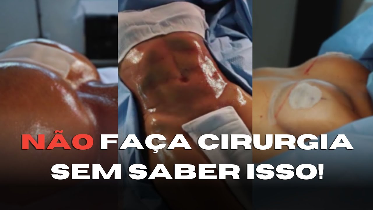 PERGUNTAS QUE TODA PACIENTE ME FAZ ANTES DA CIRURGIA! | Cirurgia Plástica | Dr. Ícaro Samuel