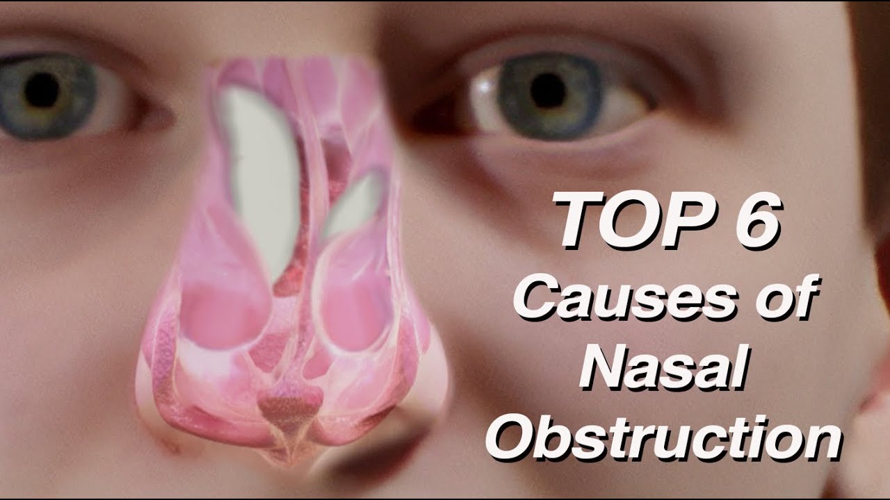 Top 6 Causes of Nasal Obstruction (Mouth Breathing)