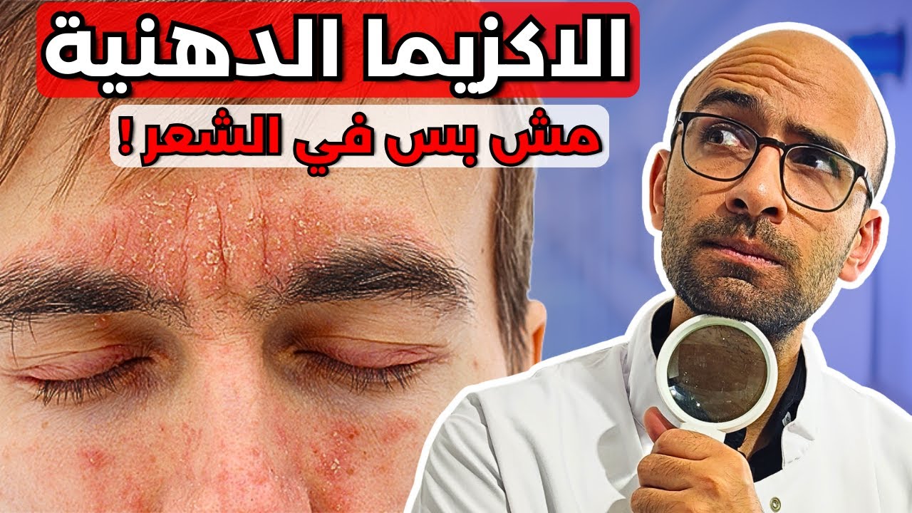 الاكزيما الدهنية | اسبابها وعلاجها | مش بس بتظهر في الشعر !