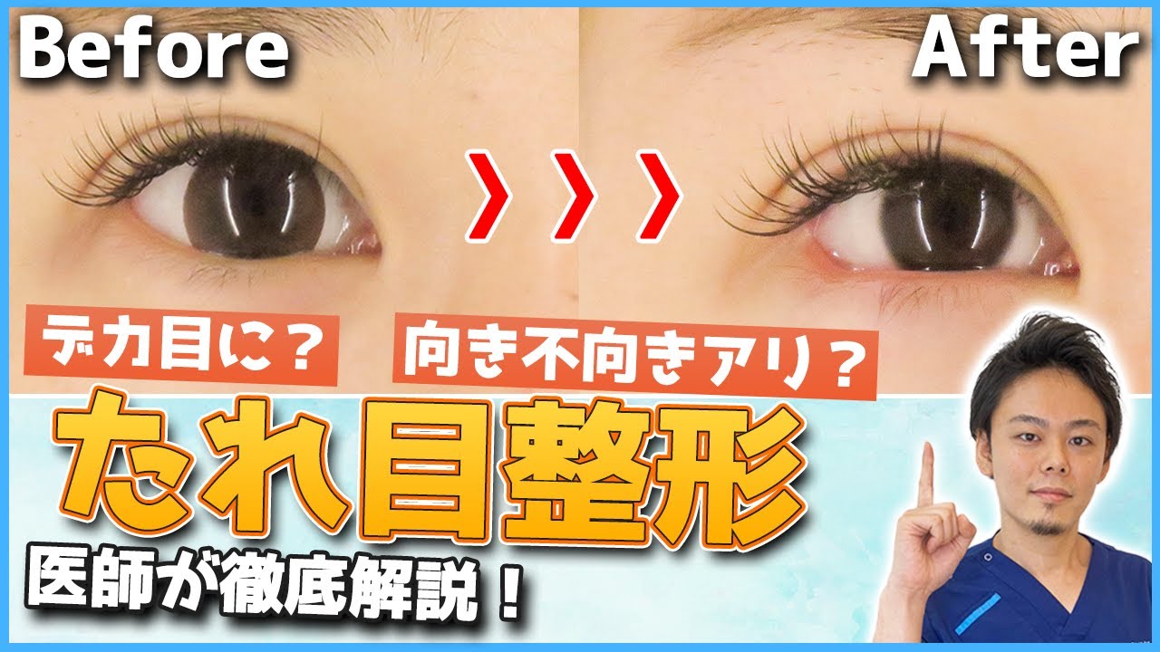 【たれ目整形】カワイイ大きな目に！？たれ目整形のデカ目効果から向き不向きまで！医師が教えます【グラマラスライン】