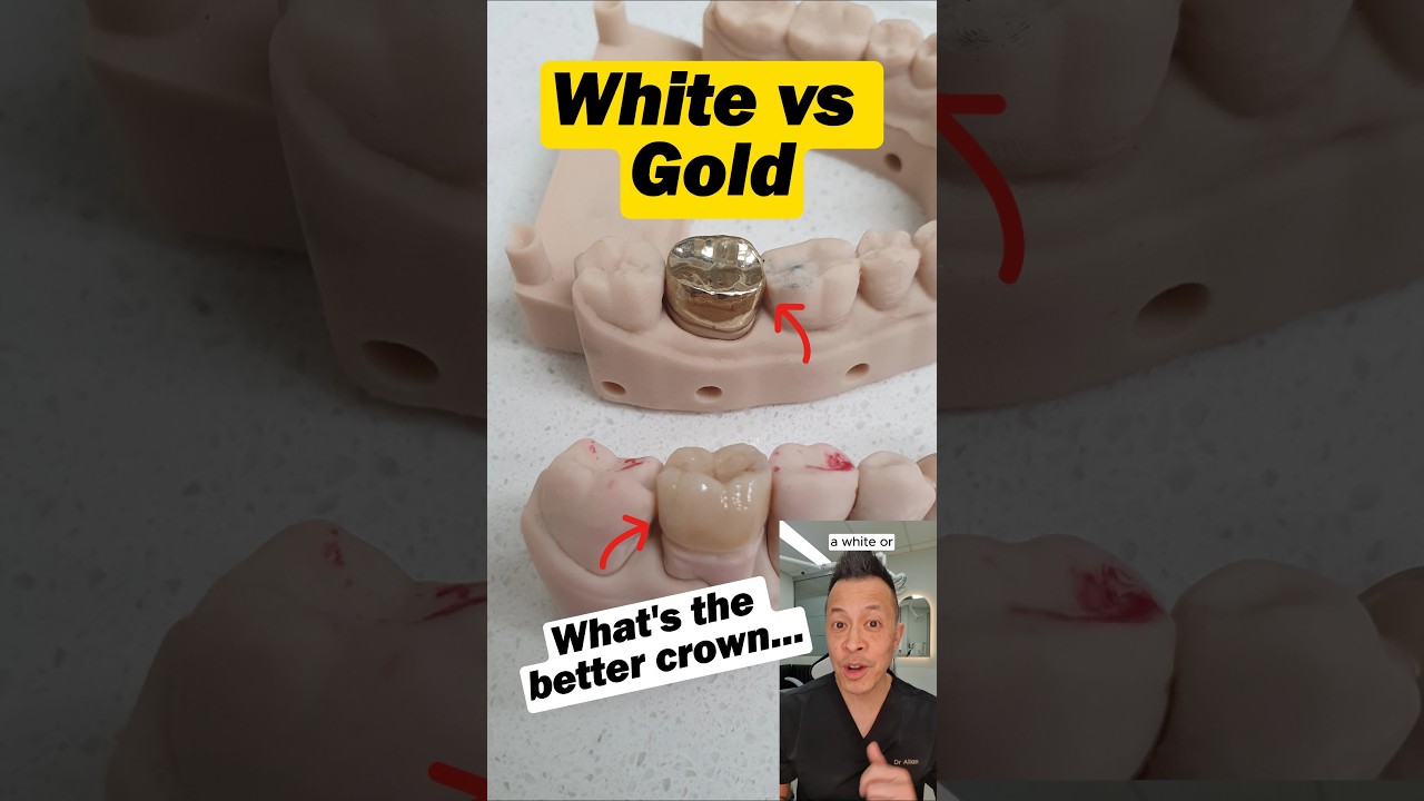 Are Gold Crowns Really Better Than White? Pros and Cons Explained! #dentist #dentallan #shorts