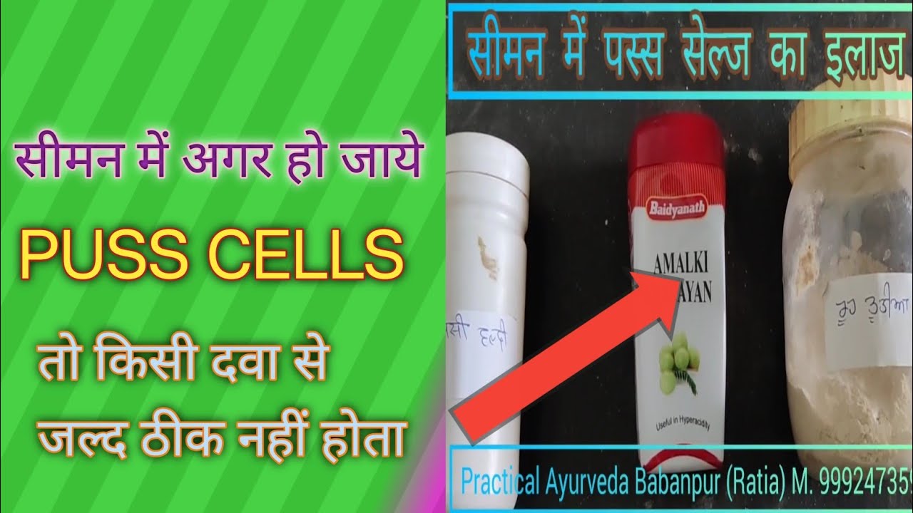 TREATMENT OF PUSS CELLS IN SPERM | PUSS CELLS KA ILAJ