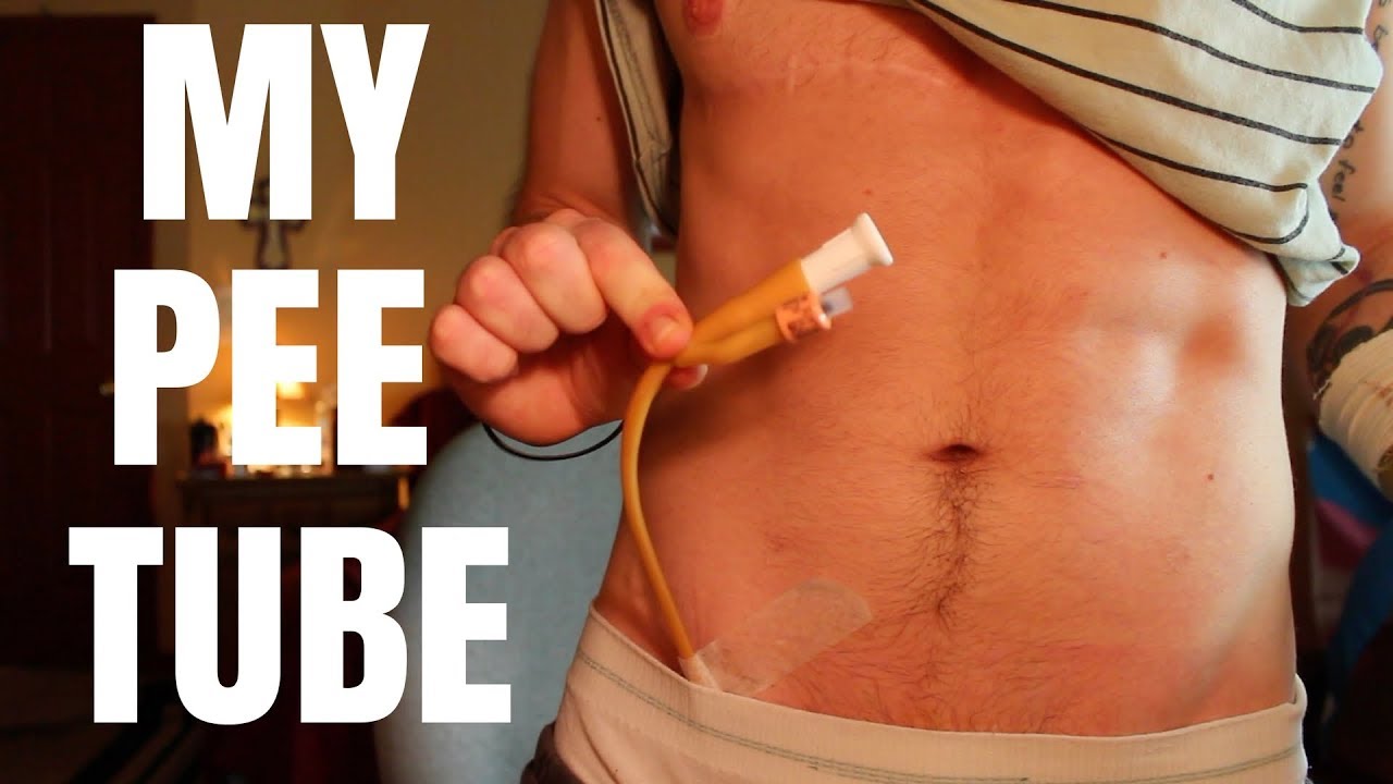 FTM Phalloplasty Supra Pubic Catheter