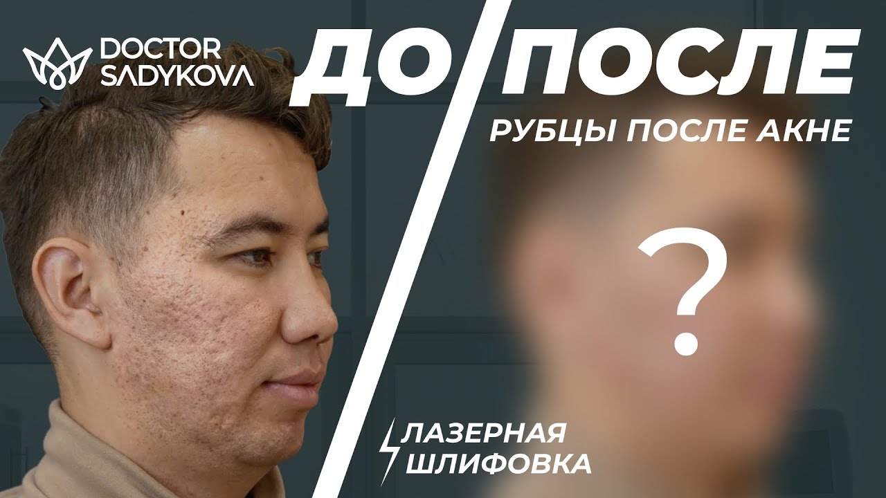 ЛАЗЕРНАЯ ШЛИФОВКА CO2: ГЛАДКАЯ КОЖА БЕЗ РУБЦОВ И ПОСТАКНЕ