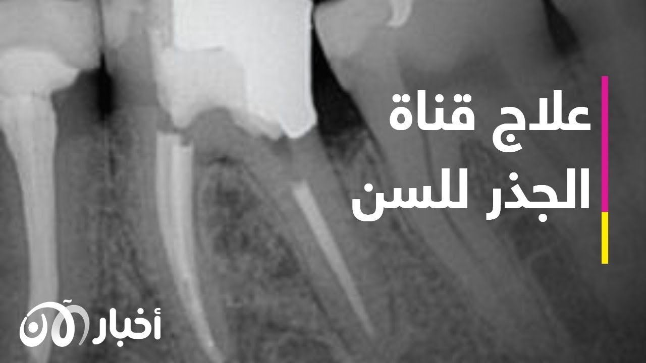 تعرف على علاج قناة الجذر للسن