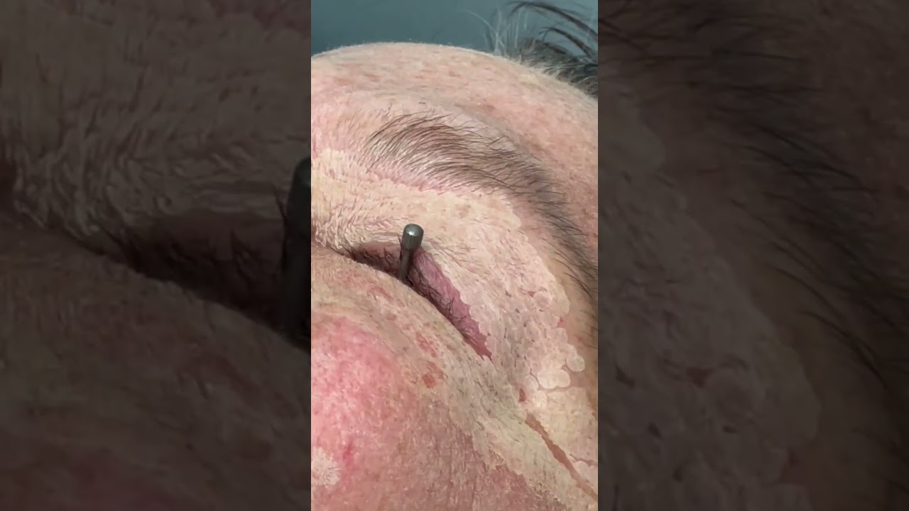 The secret to glass skin: Sciton’s Contour Peel at Seriously Skin! Laser resurfacing Chagrin Falls