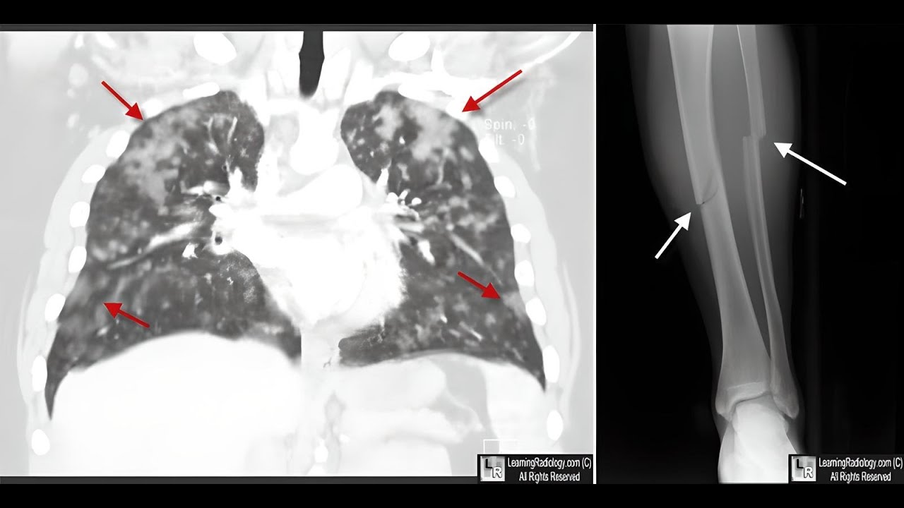 Understanding Fat Embolism Syndrome  A Comprehensive Guide for Orthopedic Surgeons.