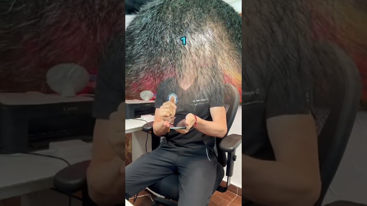 El mejor tratamiento para alopecia androgen&eacute;tica en mujeres y hombres comprobado dermat&oacute;logo militar