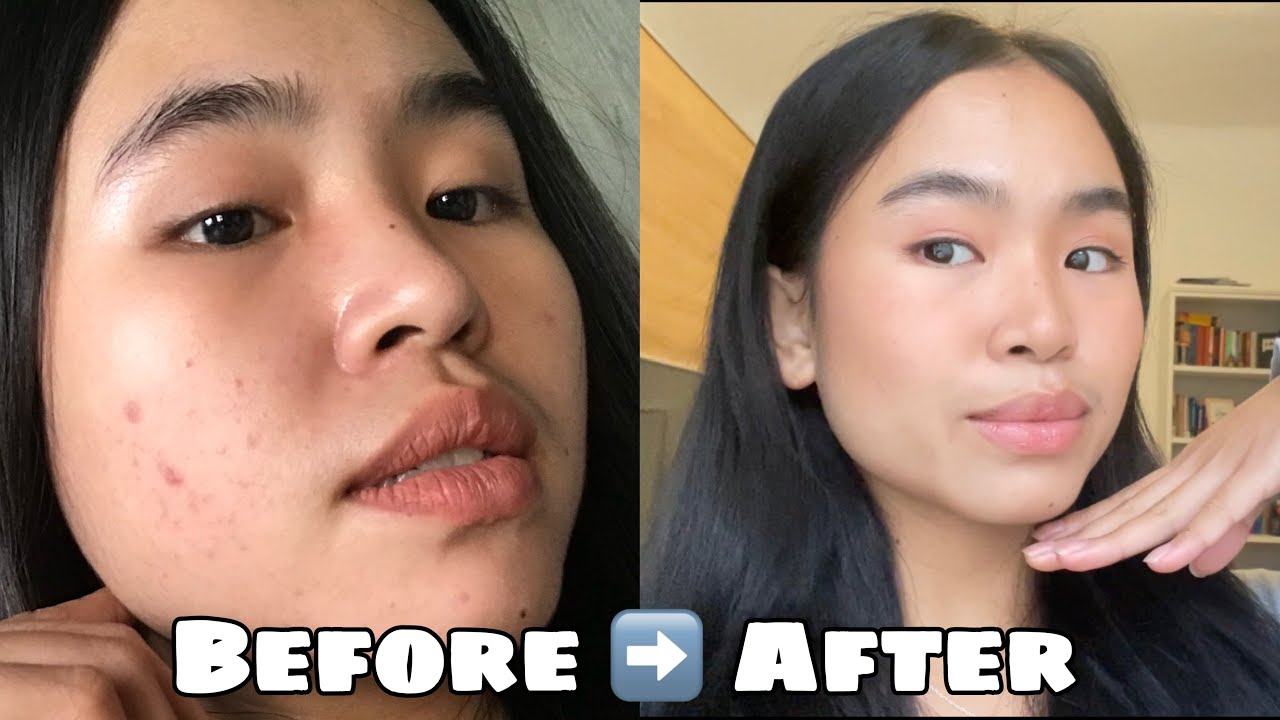 How I Got Rid of My Pimple | My Skin Care Routine | Pinay in Germany 🇩🇪
