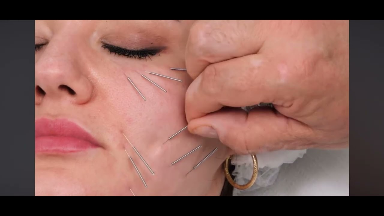 NEEDLE SHAPING