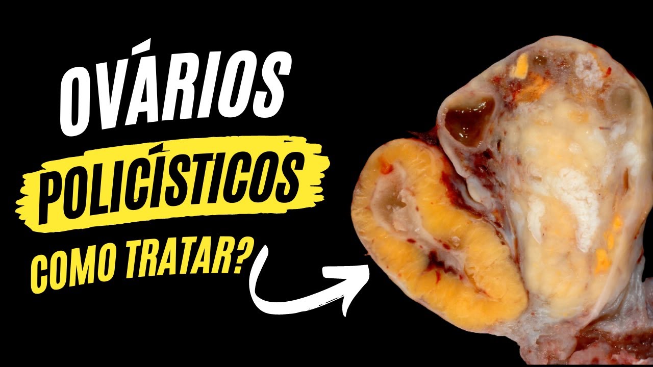 Ovários Policísticos: Sintomas, Diagnóstico e Tratamento