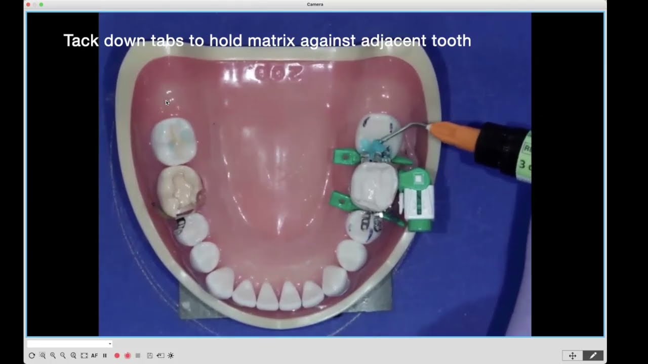 Rapid Monoblock Bulk Fill Dental Restorations - A Great Solution