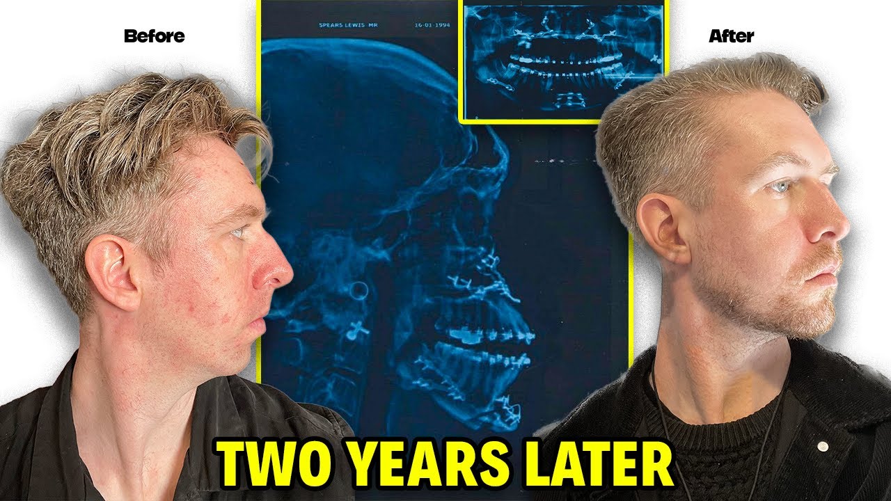 I Had Double Jaw Surgery. Here's What They DON'T Tell You.