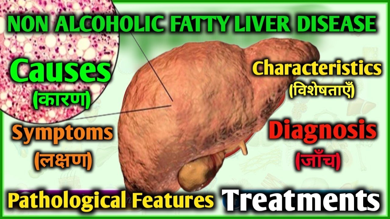 Non- Alcoholic  Fatty Liver Disease  | Causes | Patho| Symptoms | Investigation | Treatments |