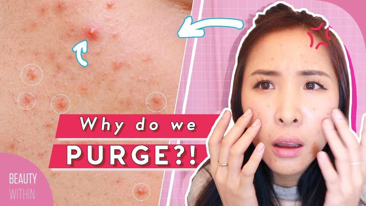 Which Products Cause Skin Purging? 🌋 Tips for All Skin Types
