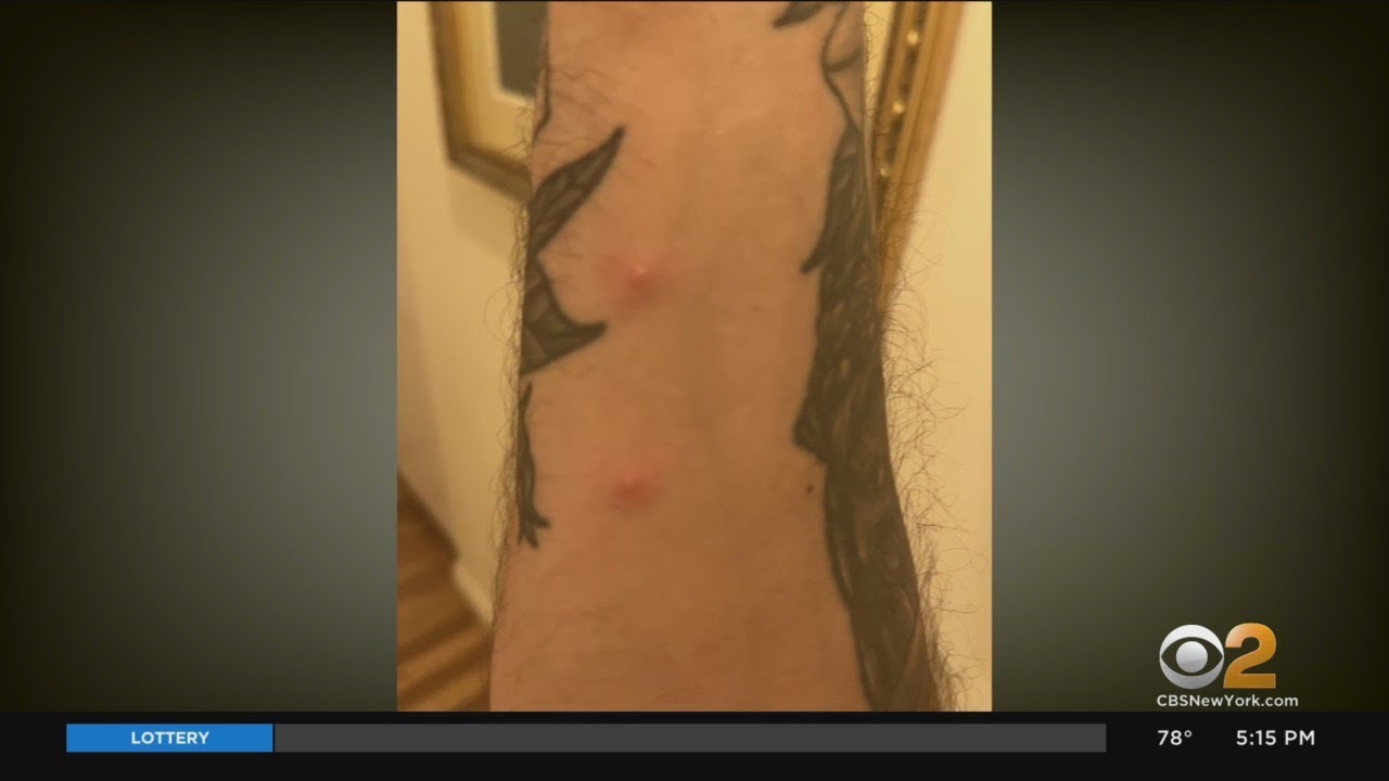 Man with monkeypox describes symptoms