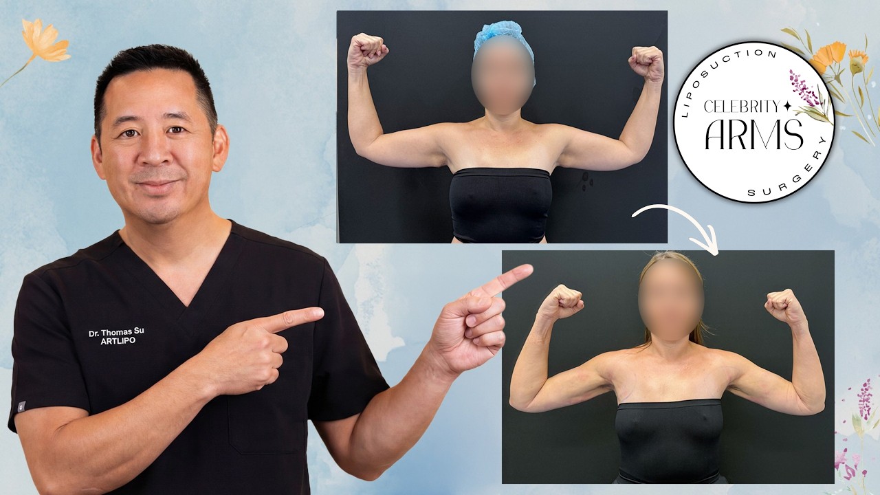 Она думала, что у неё нет рельефа мышц... А потом случилось это 😱 | Celebrity Arms&trade; Липосакция в ...