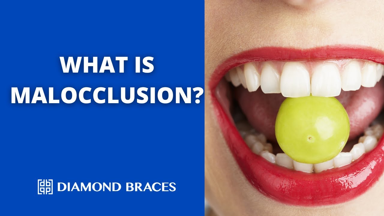 Malocclusion: Understanding Misaligned Bites and Their Treatment