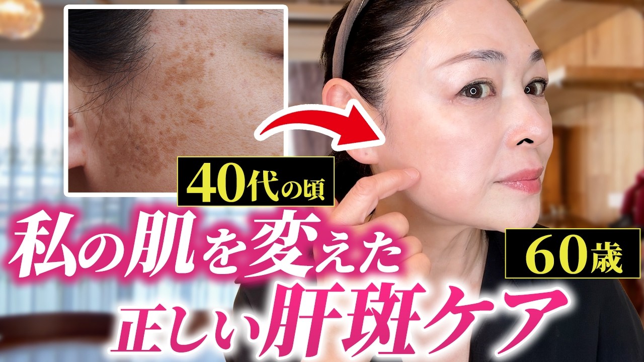 【肝斑改善】厄介な肝斑を消すスキンケアを美肌のプロが解説！小顔ローラーはまじで要注意です