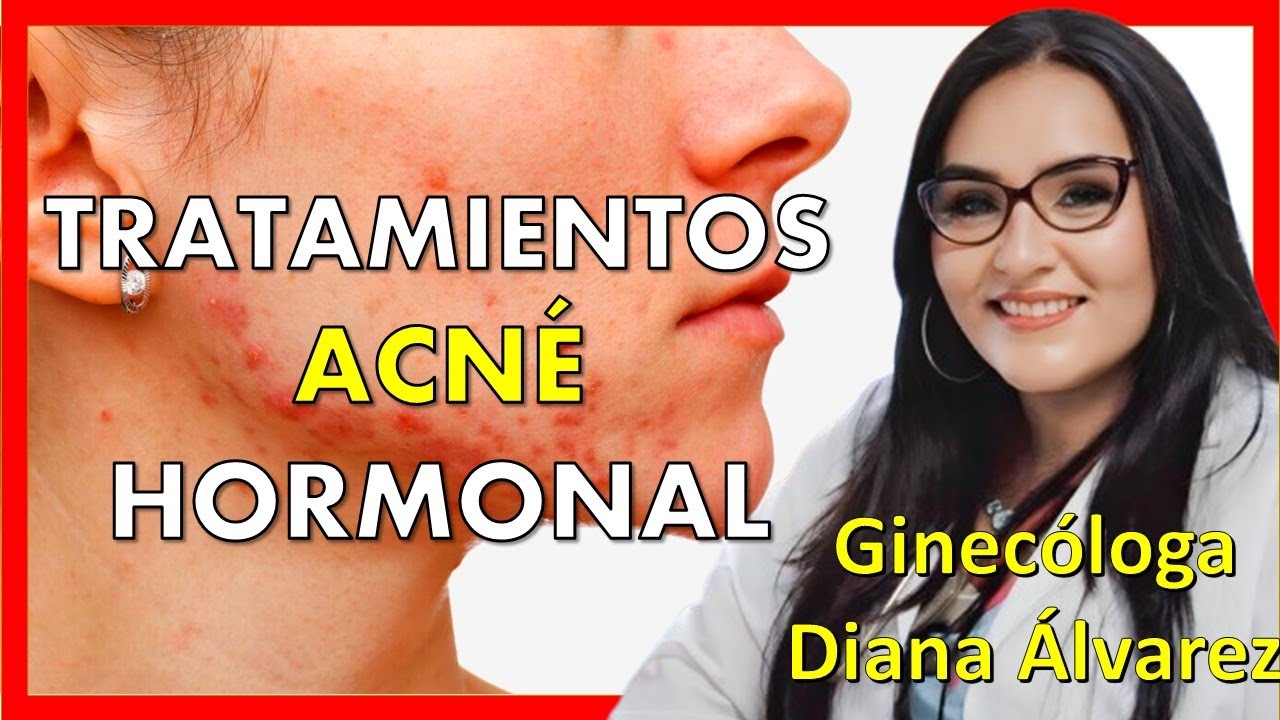 TRATAMIENTO del ACNE HORMONAL |Ginecologa Diana Alvarez