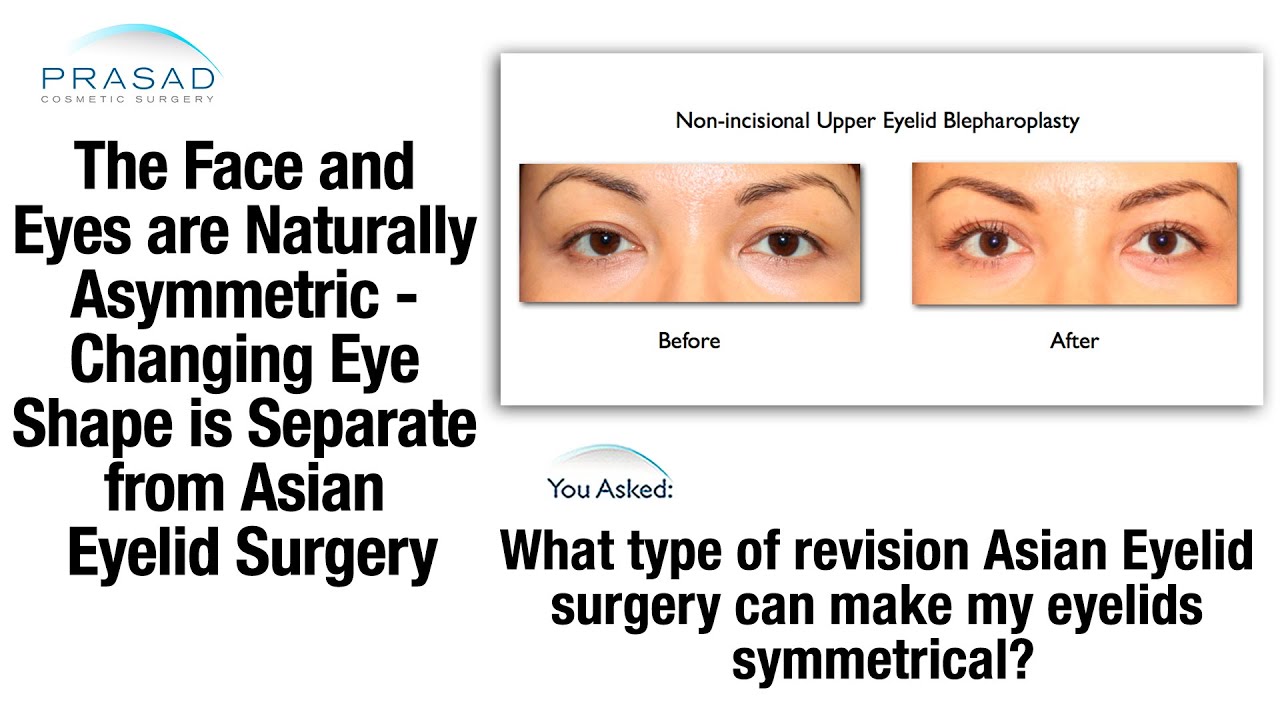 Asian Eyelid Surgery Creates an Eyelid Crease; Almond Eyes Surgery Changes Eyelid Shape