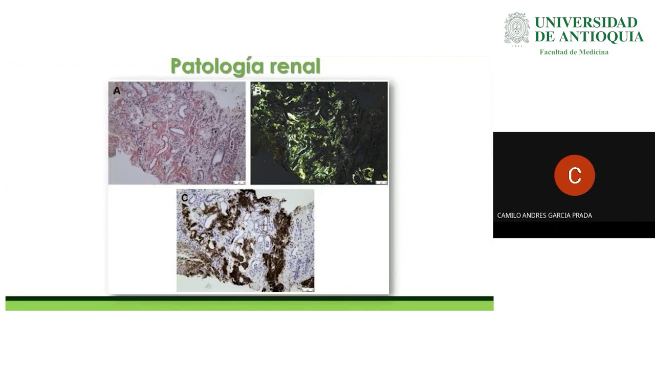 Amiloidosis y Enfermedad Renal - Dr. Camilo Andrés García