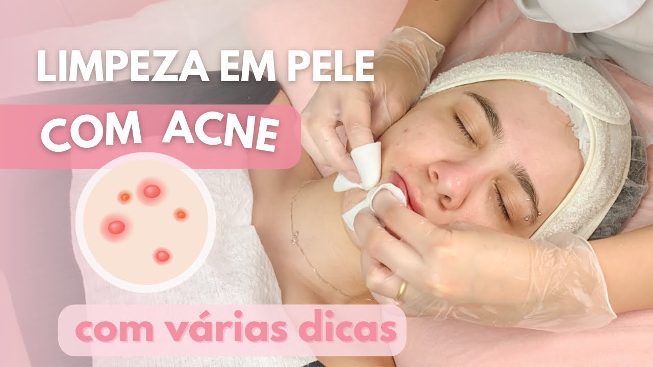LIMPEZA DE PELE PROFISSIONAL EM PELE COM ACNE GRAU 2
