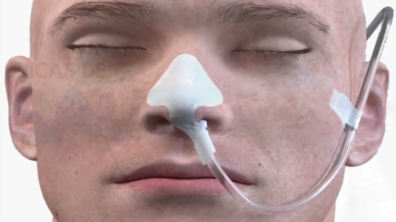 Administração via sonda nasal gástrico