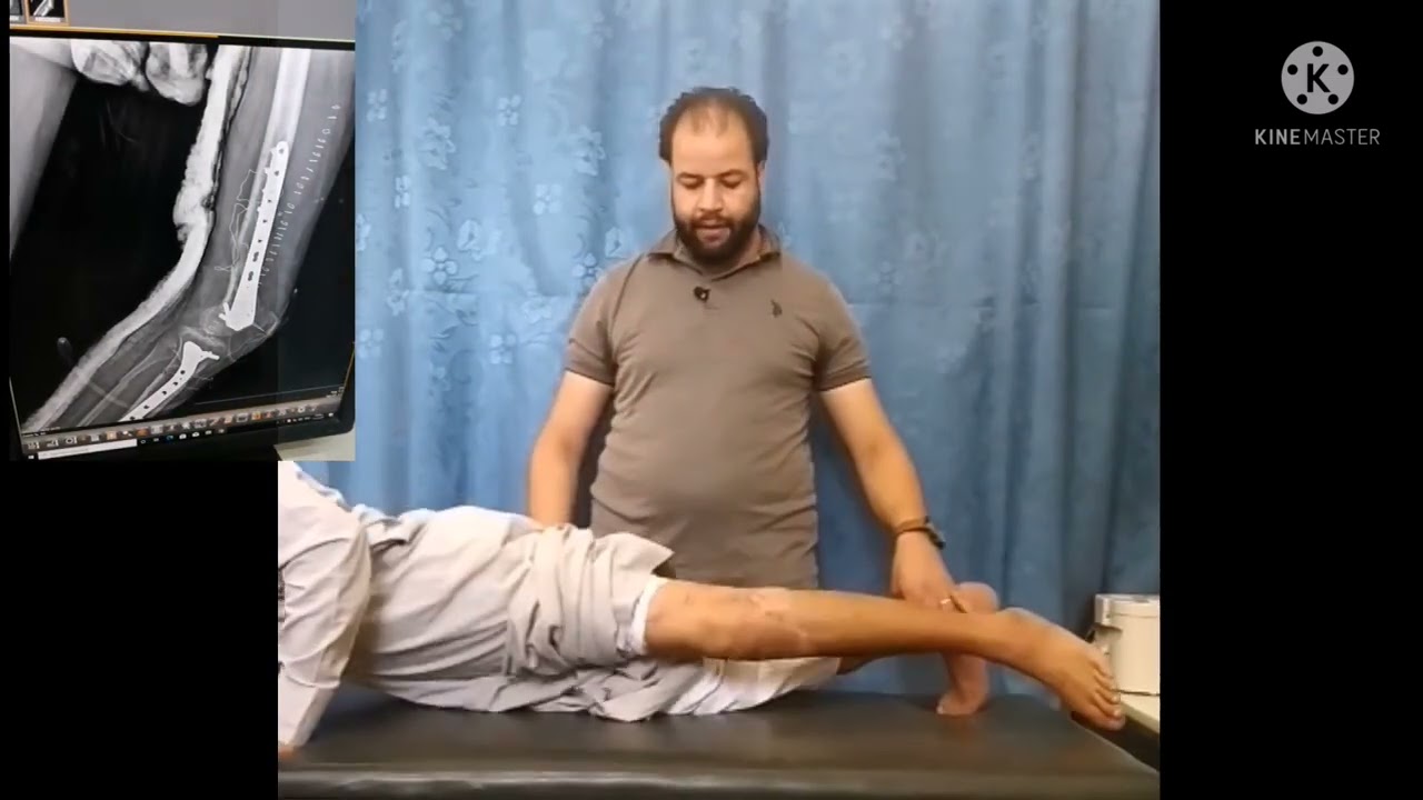 # علاج تكلس الركبة _نتيجة كسر  في الفخذ والساق  _ مع تقوية لعضلة _ الفخذ _ والساق #