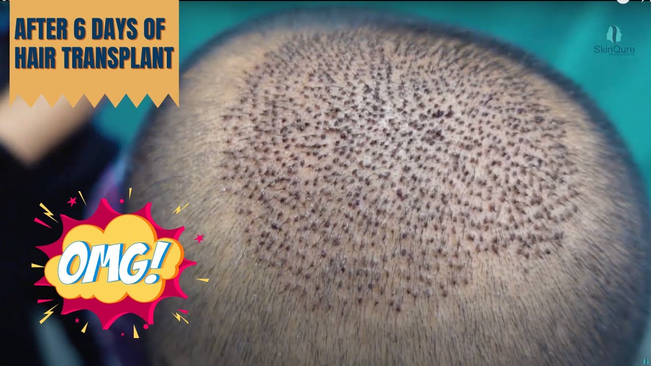 Scab Formation Explained | Overview after 6 days of Hair Transplant | Best Hair Transplant-Dr Jangid