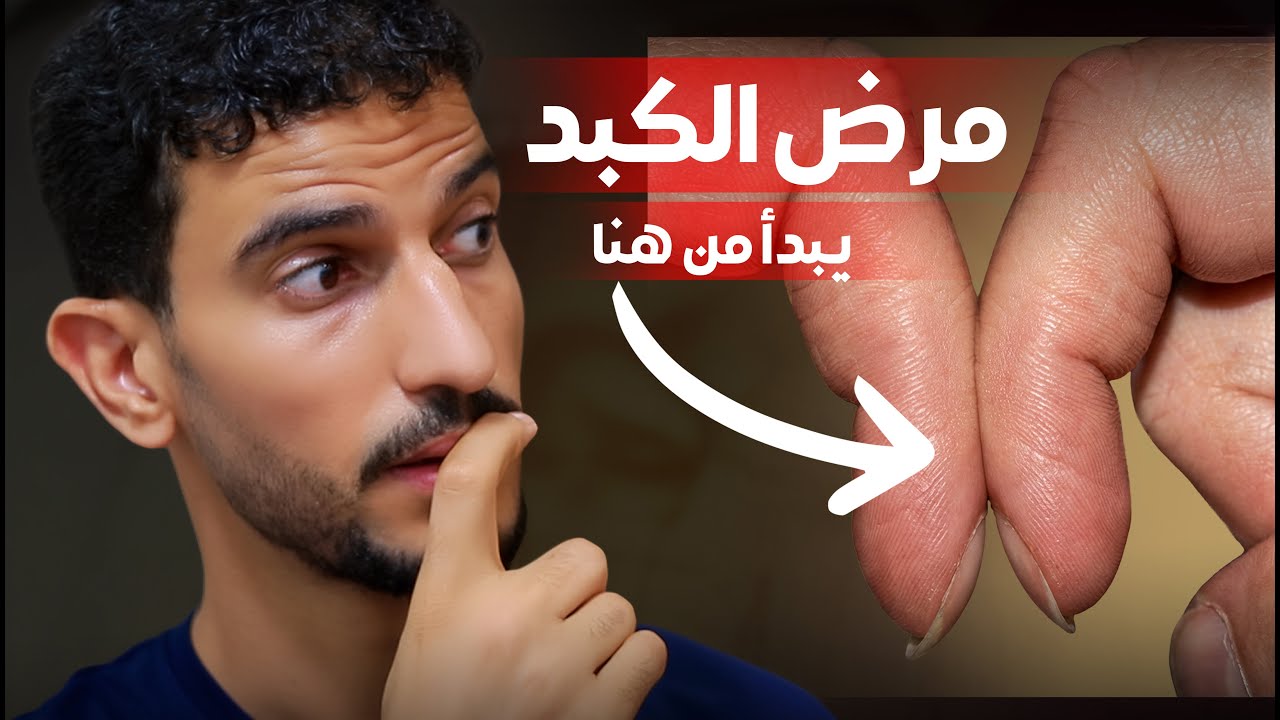 10علامات لمرض الكبد يمكنك رؤيتها !