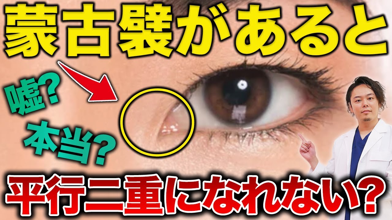 【二重整形】蒙古襞があると平行二重になれないって本当？