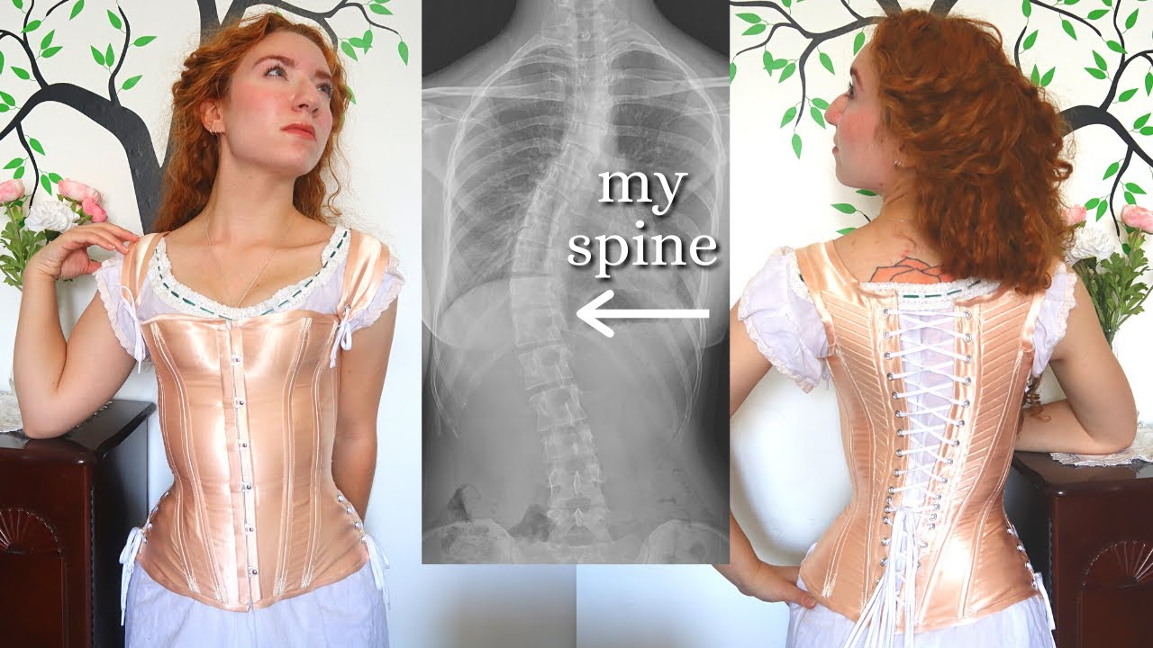 I made a custom corset for my back pain! Feat. Victorian medical history, scoliosis, and ableism